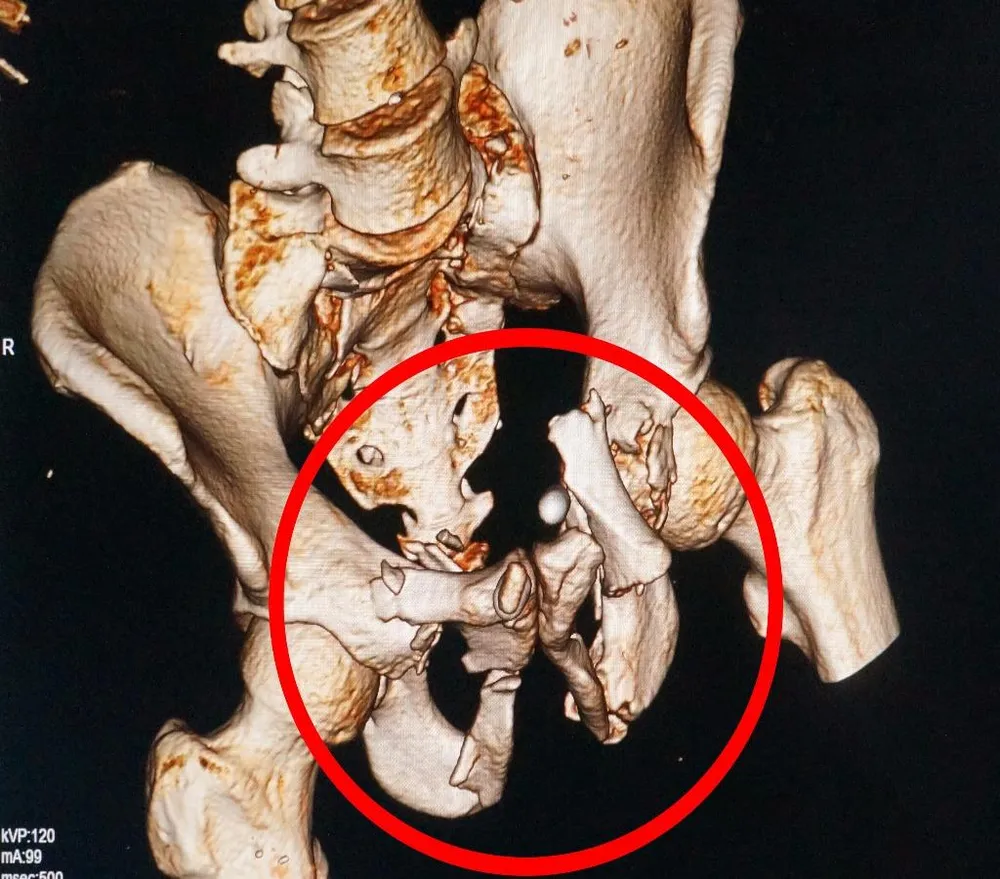 xquang xương chậu bị gãy